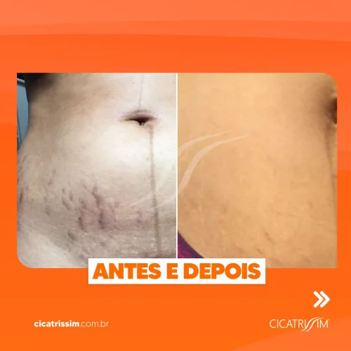 Antes e Depois Cicatrissim 3