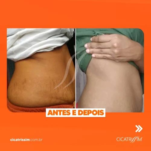 Antes e Depois Cicatrissim 1